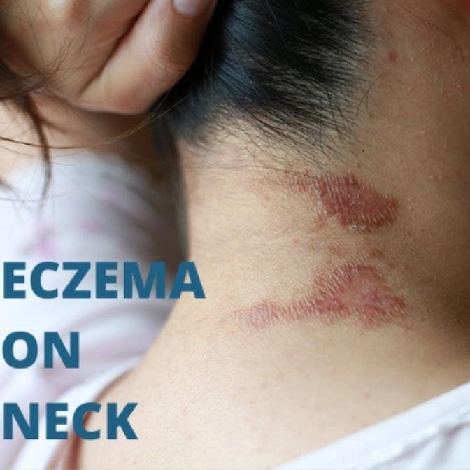 Eczema on the Face and Neck: Causes and Treatment