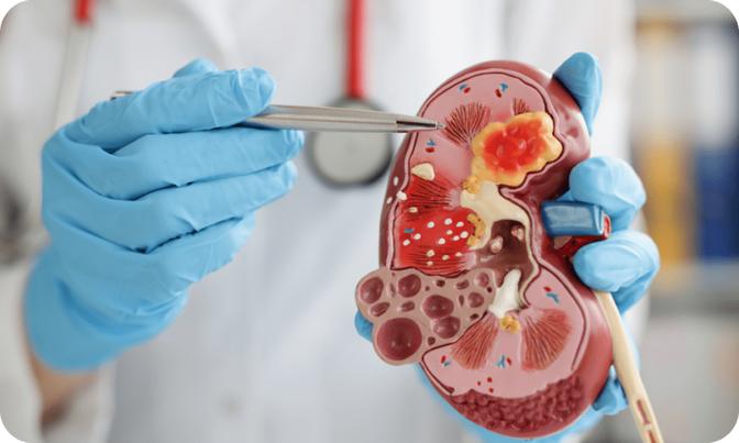 Best urologist in Bengaluru: Top Urologist Dr. Anil Kumar T’s Expertise in Tumor Treatment