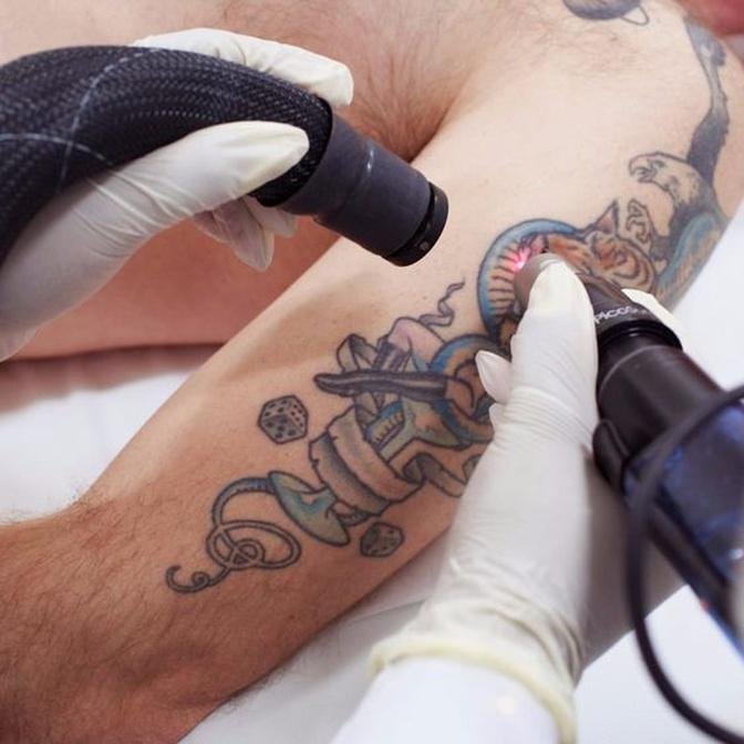 How to Choose the Right Laser Tattoo Removal Package in Dubai