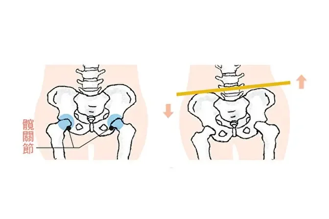 骨盆不正讓你腰痛？3招自我檢測骨盆歪斜