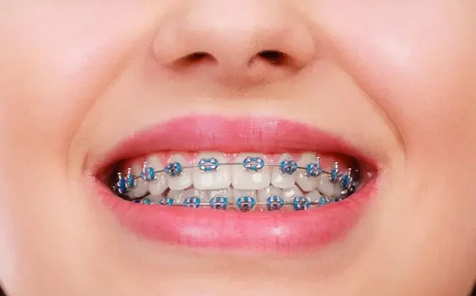 Smile Makeovers with Metal Braces: Transforming Lives in Dubai