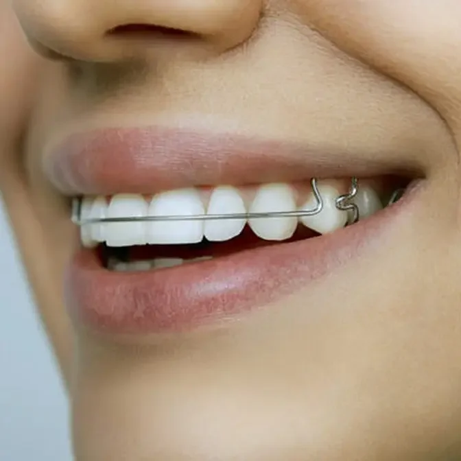 Dental Retainers for Adults: A Guide to Maintaining Your Smile in Dubai