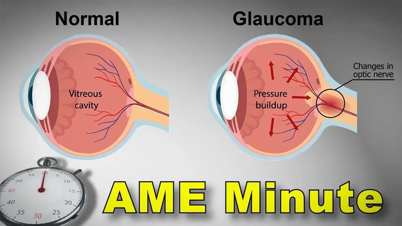 AME Minute: Why is a pilot’s age relevant to a CACI issuance for glaucoma?