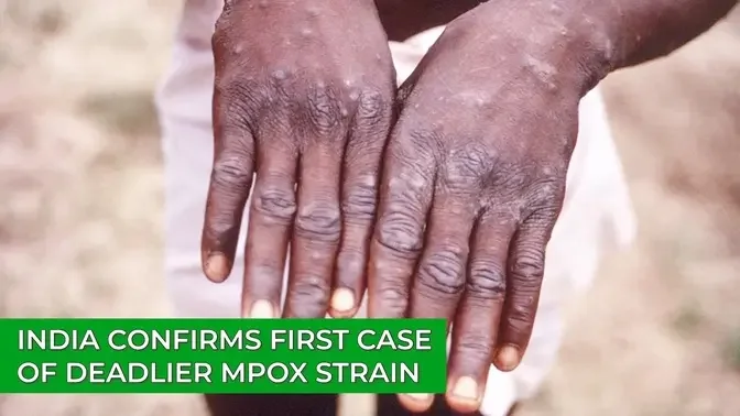 India Confirms First Case of Deadlier Mpox Strain