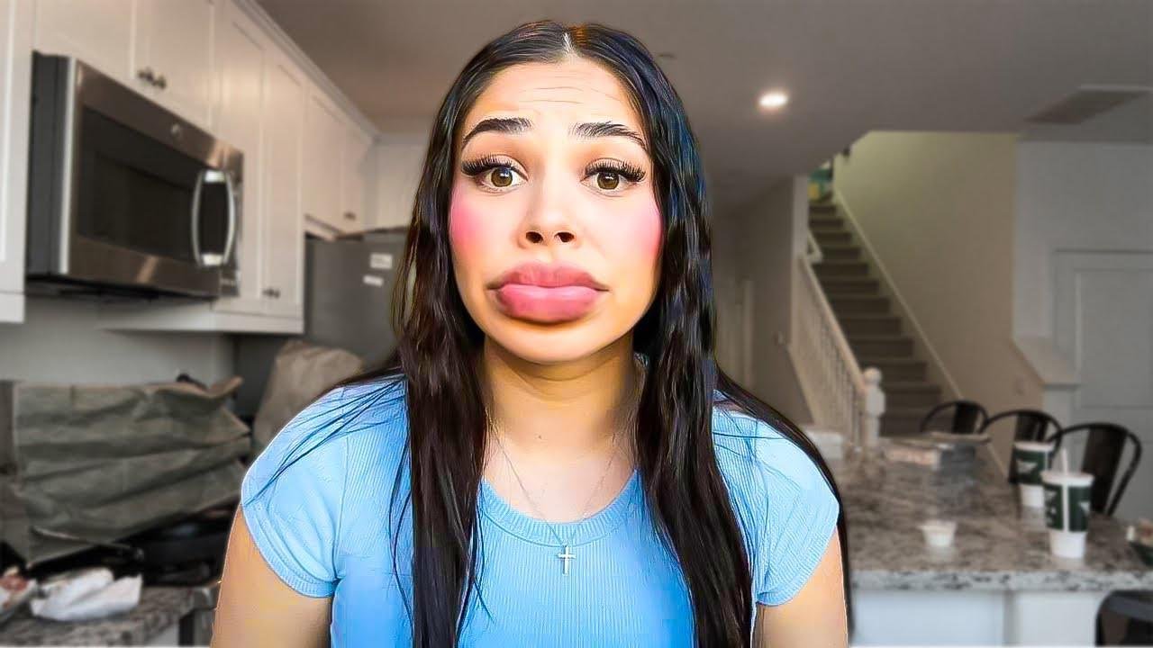 MY LIP FILLER EXPERIENCE *GONE WRONG*