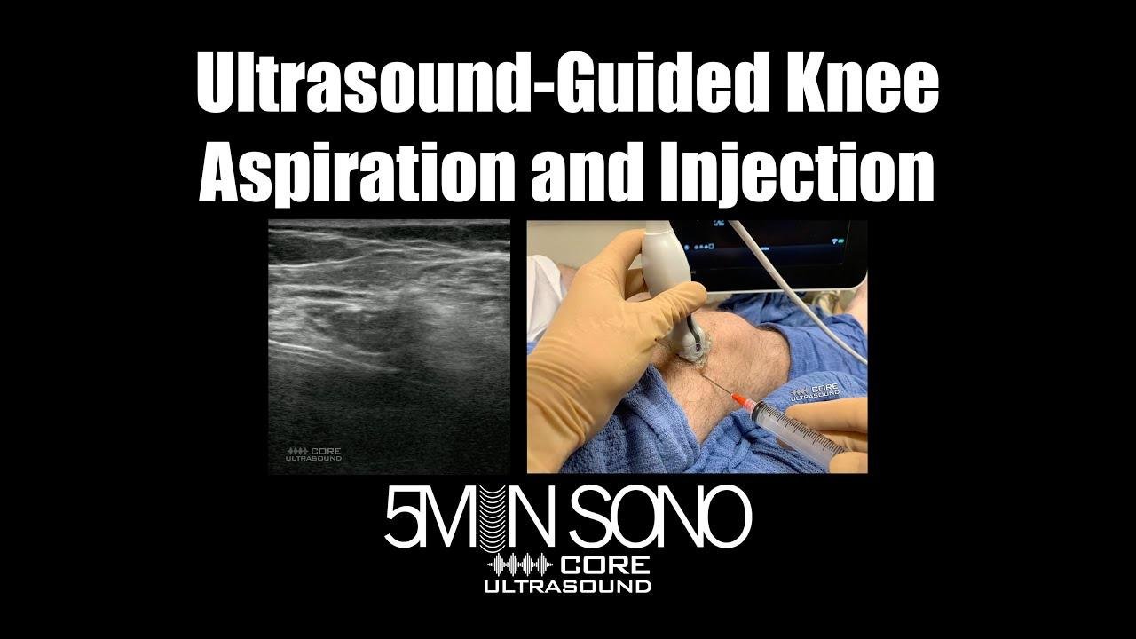 Ultrasound-Guided Knee Aspiration and Injection: A Step-by-Step Guide