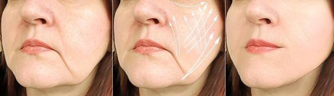 Crack the Code: Navigating Chin Liposuction Costs in Dubai