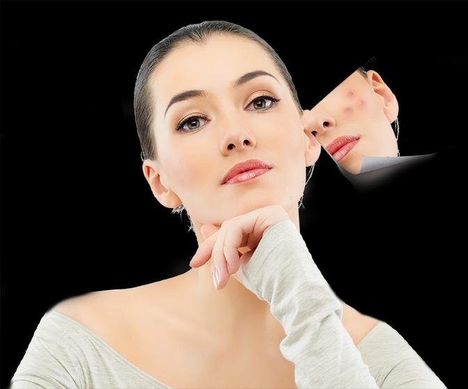 Unveiling the Fast Track to Clear Skin: Acne Scars Treatment in Dubai