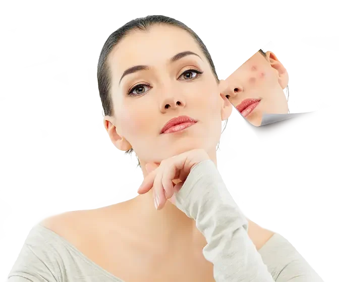 Unveiling the Fast Track to Clear Skin: Acne Scars Treatment in Dubai