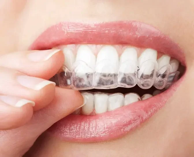 Transform Your Dental Alignment: Overlapping Teeth Treatment in Dubai