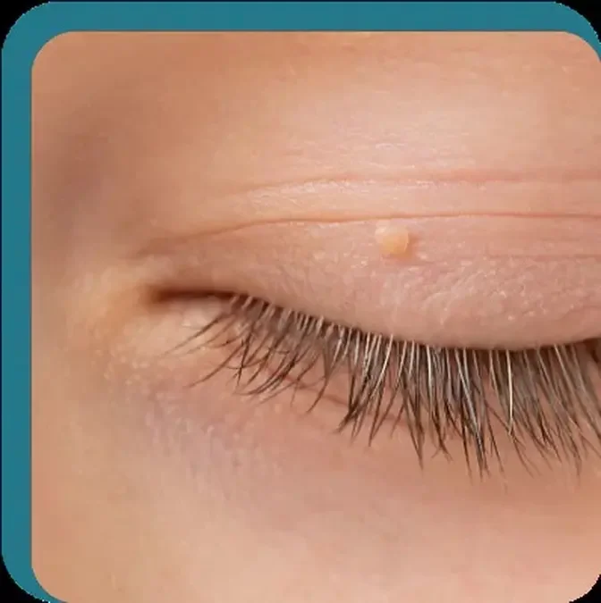 Surgical Removal of Eyelid Tags: Procedures, Benefits, and Recovery