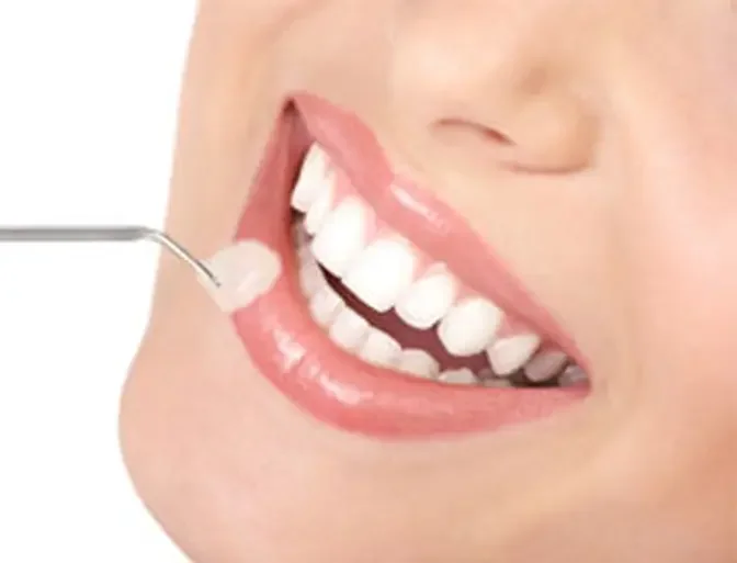 How Much Can I Expect to Pay for Composite Veneers in Dubai?