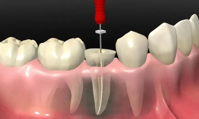 Beyond the First Round: Investigating the Potential for Repeated Root Canals