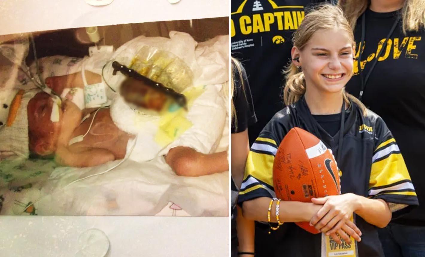 Premature Twin Born with Organs Outside Her Body Defies the Odds and Thrives